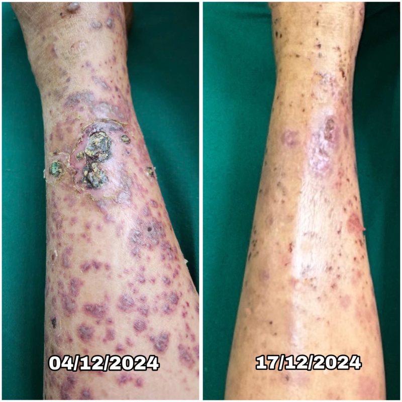 Bệnh Viện Phong Và Da Liễu Sơn La