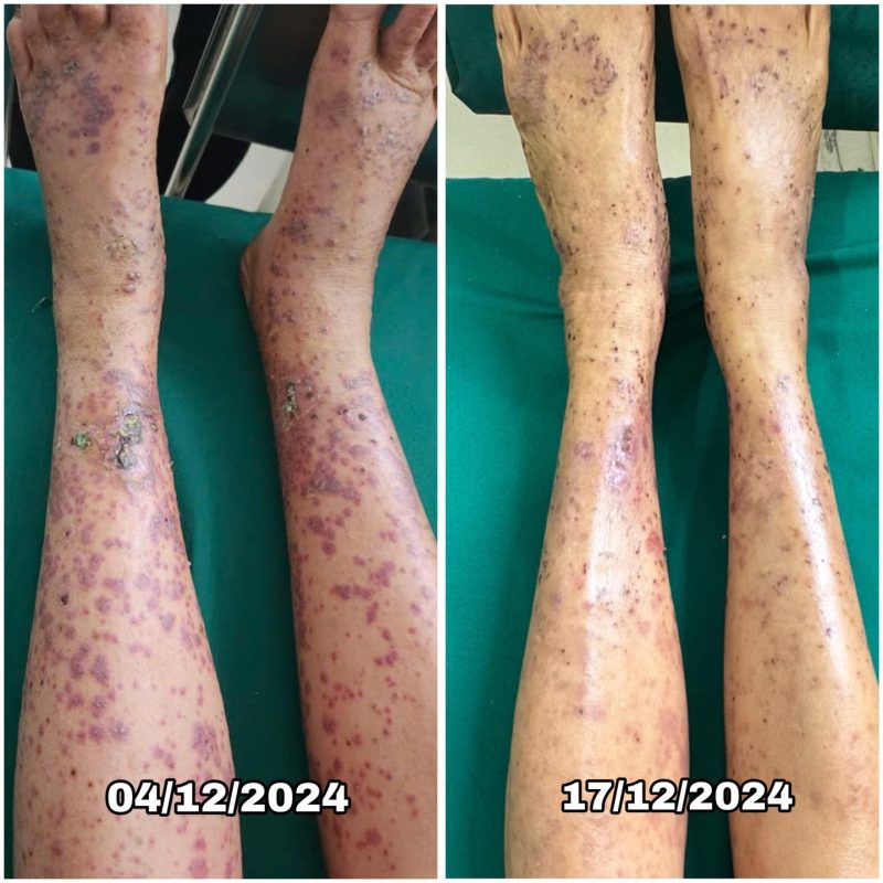 Bệnh Viện Phong Và Da Liễu Sơn La